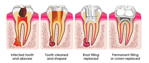Tooth Filling 1 Tooth Filling 1