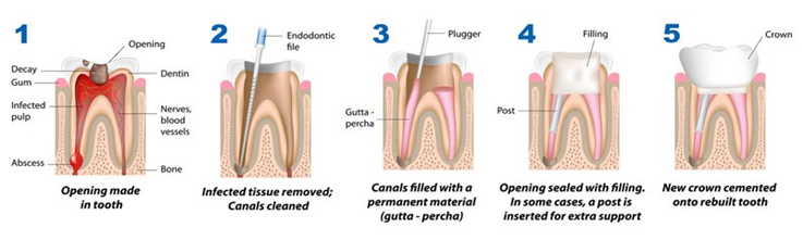 Tooth Filling Tooth Filling